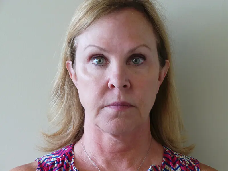 Facelift Patient Before