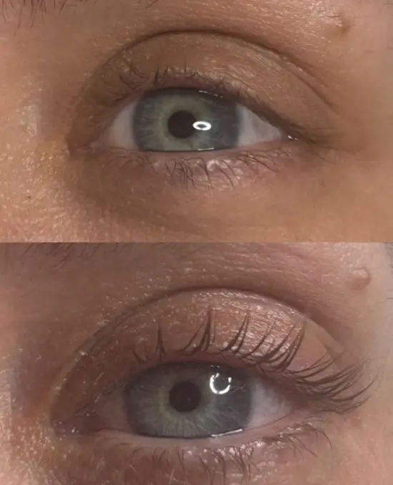 Before and After LATISSE