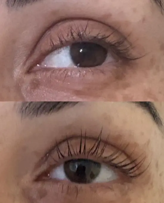 Before and After LATISSE