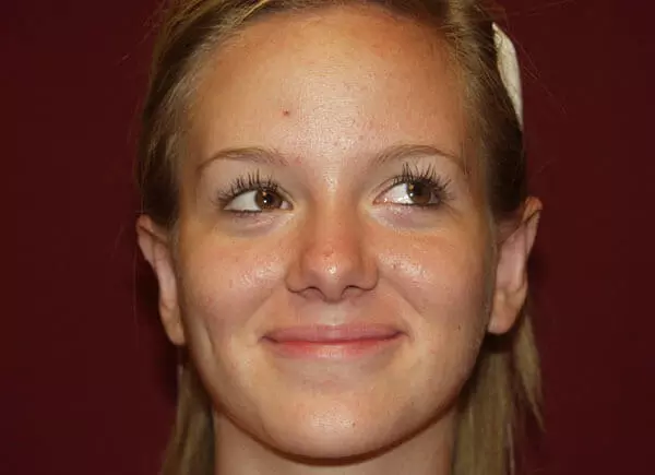 Otoplasty (Ear Surgery) in Sacramento Patient After