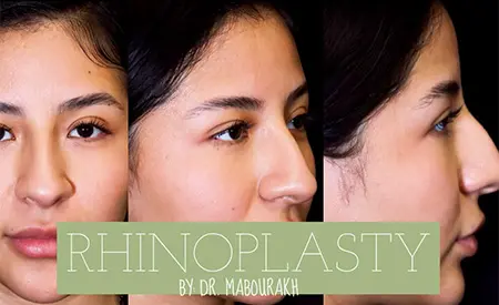 before and ater results of rhinoplasty surgery