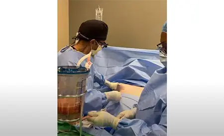 Dr. Mabourakh performing fat transfer to breasts