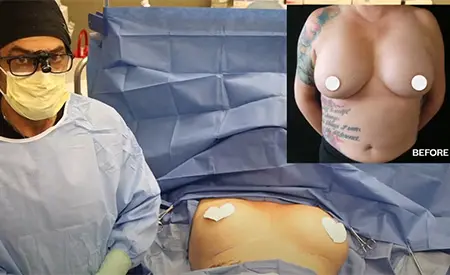 Dr. Mabourakh describing breast implant replacement surgery