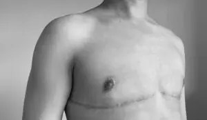 Black-and-white depiction of scarring on the lower chest following FTM top surgery