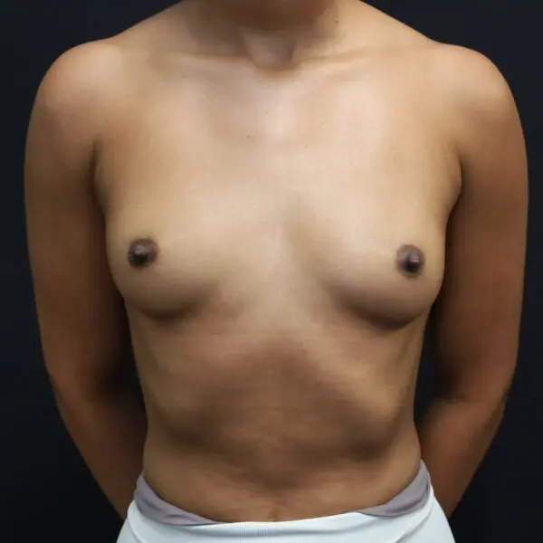 Breast Aug #4480 Before 1