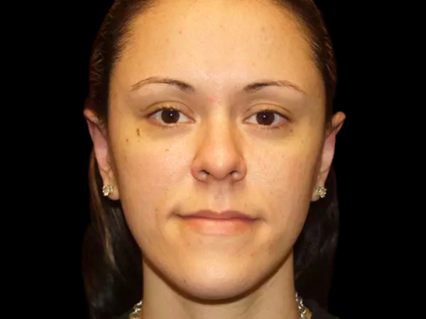 Otoplasty Patient 05 After 1