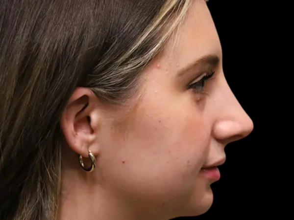 Rhinoplasty Patient 46 After 1