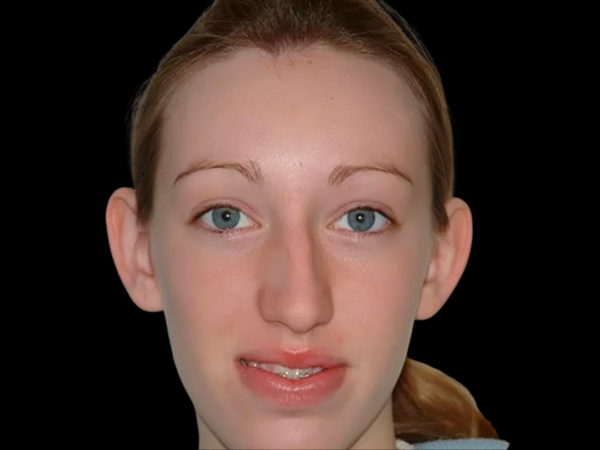 Otoplasty Patient 02 Before 1