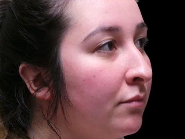 Rhinoplasty Patient 44 Before 2