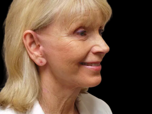 FaceLift Patient 13 After 2