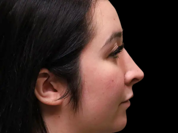 Rhinoplasty Patient 44 After 1