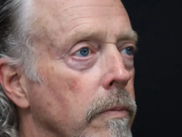 Eyelid Surgery Patient 25 Before 1