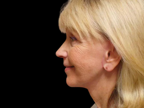 FaceLift Patient 13 After 1