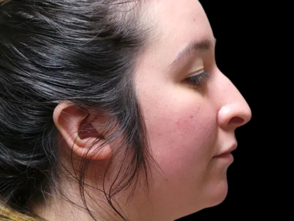 Rhinoplasty Patient 44 Before 1