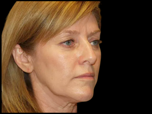 FaceLift Patient 14 Before 2