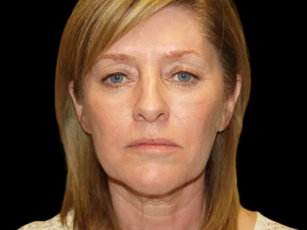FaceLift Patient 14 Before 1