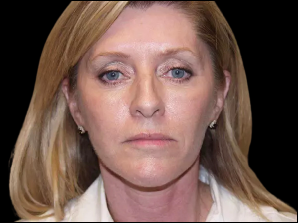 FaceLift Patient 14 After 1