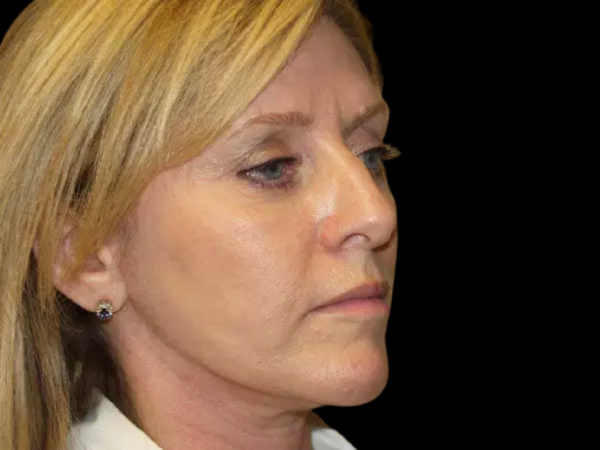 FaceLift Patient 14 After 2