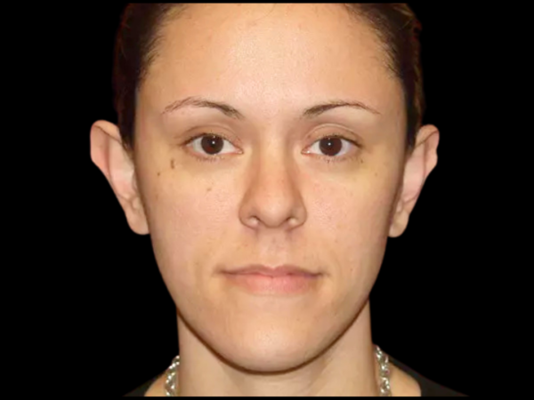 Otoplasty Patient 05 Before 1