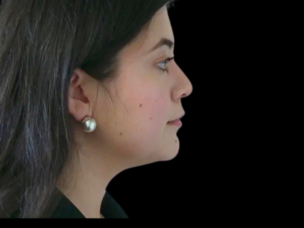 Liposuction Patient 09 Before 2