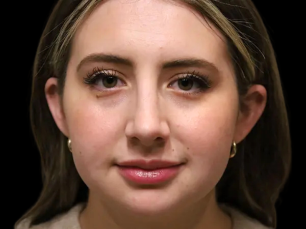 Rhinoplasty Patient 46 After 2