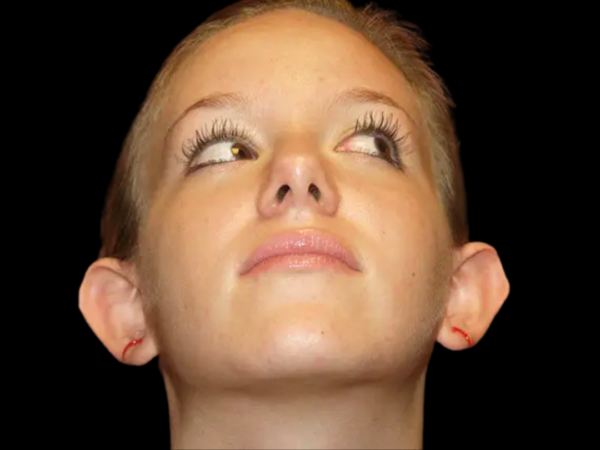 Otoplasty Patient 04 Before 2