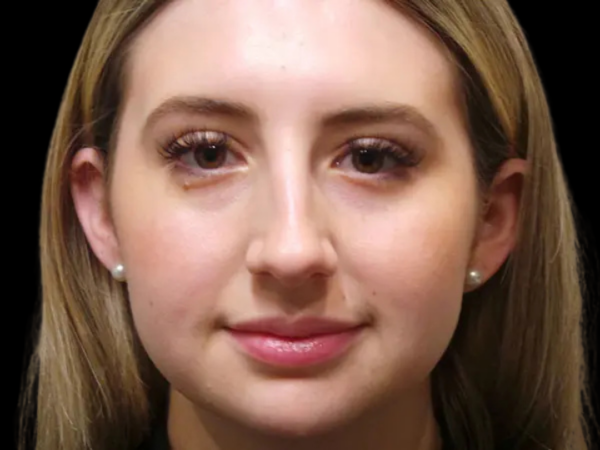 Rhinoplasty Patient 46 Before 2