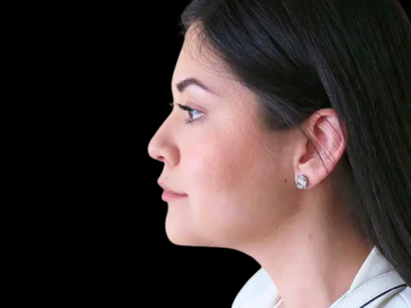 Liposuction Patient 09 After 1