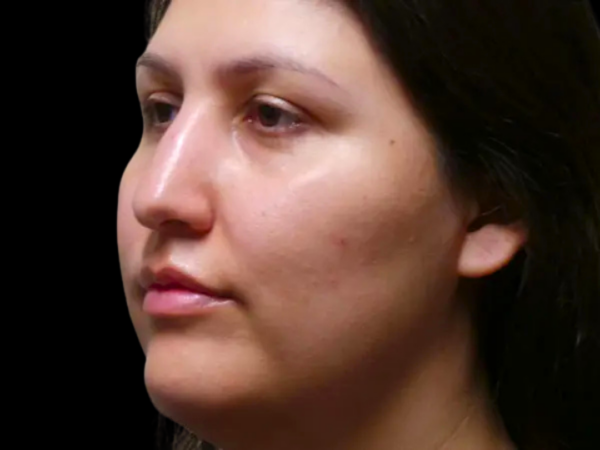 Rhinoplasty Patient 45 Before 2