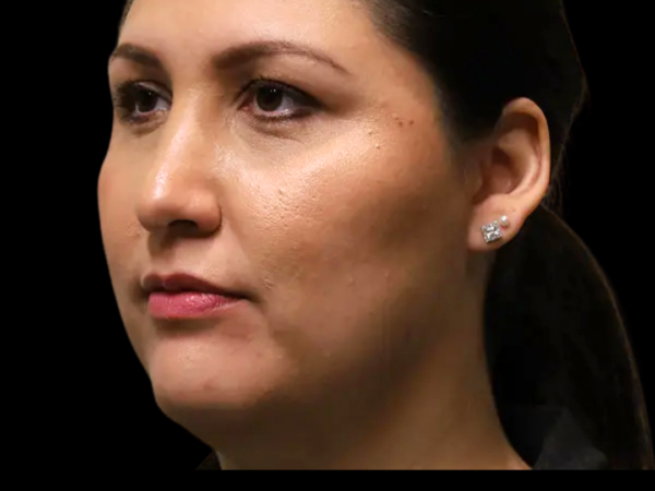 Rhinoplasty Patient 45 After 2