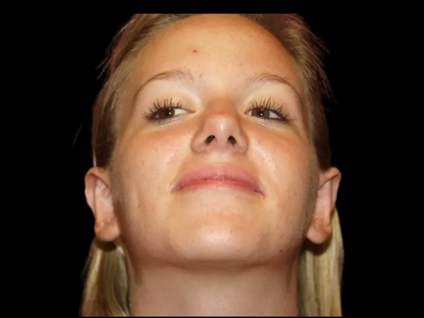 Otoplasty Patient 04 After 2