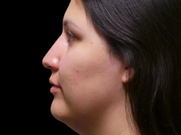 Rhinoplasty Patient 45 Before 1
