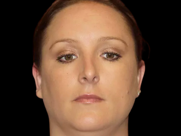 Otoplasty Patient 03 After 1