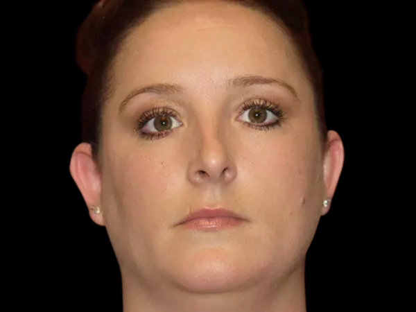 Otoplasty Patient 03 Before 1