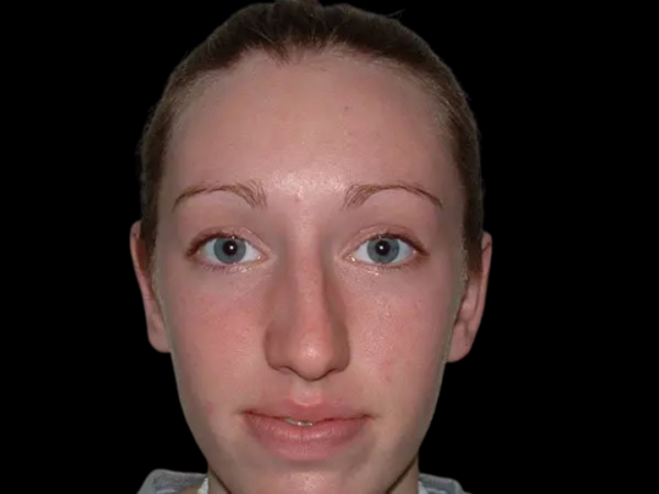 Otoplasty Patient 02 After 1