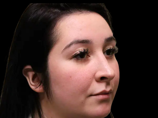 Rhinoplasty Patient 44 After 2