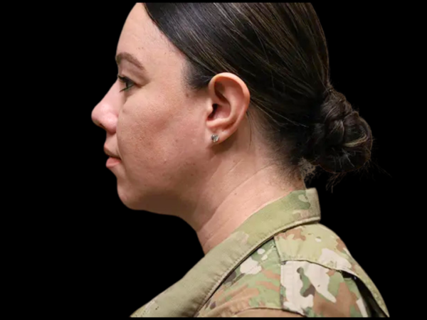 Neck Liposuction Patient 1 Before 1