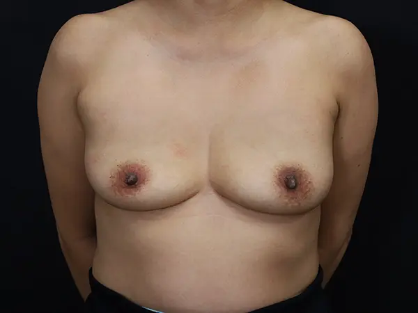 Breast Implant Removal Patient 16 After 1