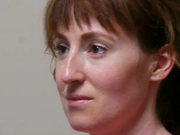 Rhinoplasty Patient 50 Before 2