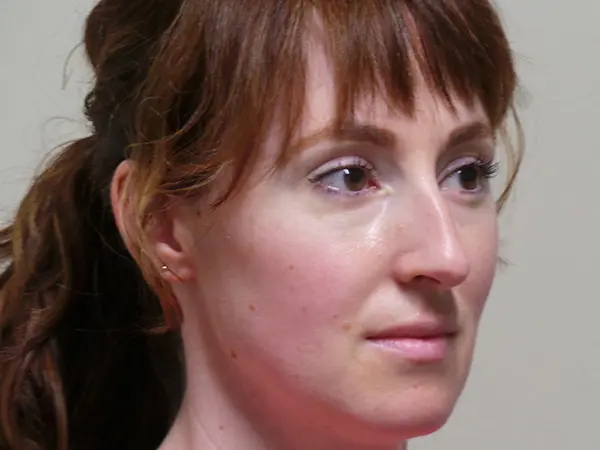 Rhinoplasty Patient 50 Before 1