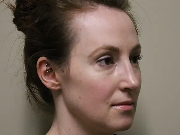 Rhinoplasty Patient 50 After 1