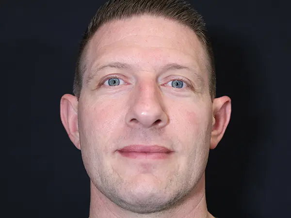 Otoplasty Patient 06 After 1