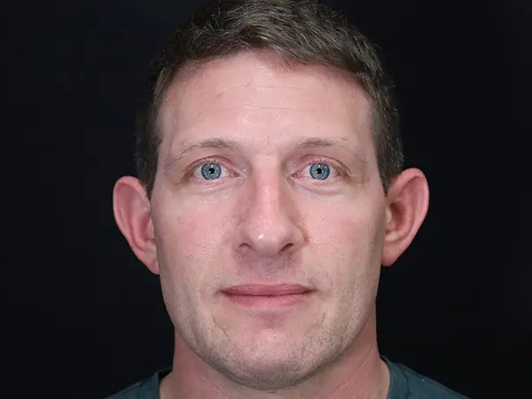 Otoplasty Patient 06 Before 1