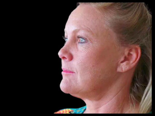 Brow Lift Patient 02 After 1