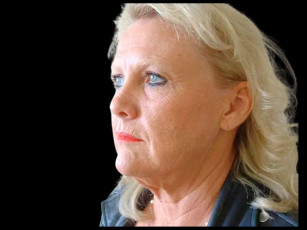 Brow Lift Patient 02 Before 1