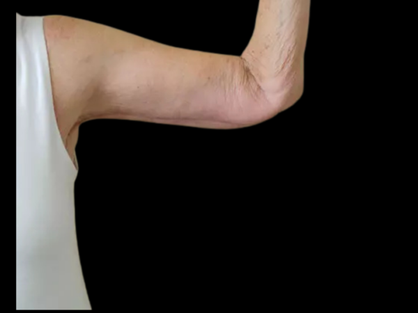 Arm Lift Patient 02 After 2