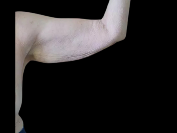 Arm Lift Patient 02 Before 2