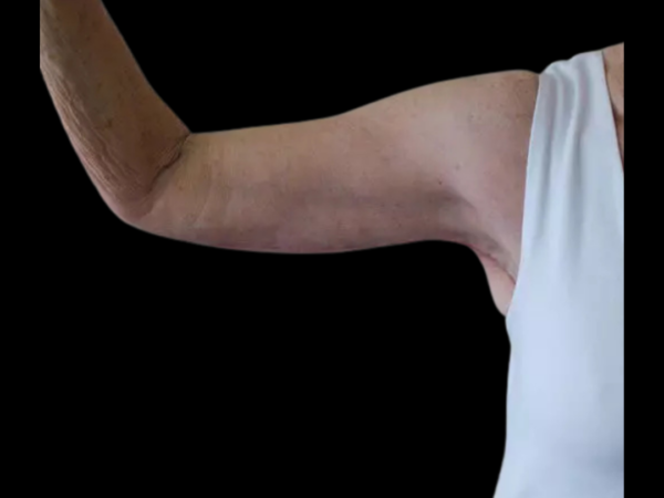 Arm Lift Patient 02 After 1