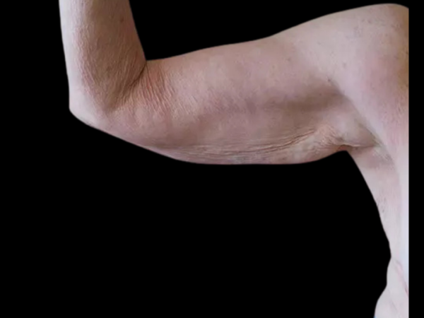 Arm Lift Patient 02 Before 1