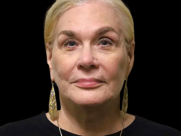 FaceLift Patient 15 After 1